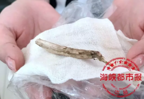 隆鼻后先后发炎 取出的假体发黑